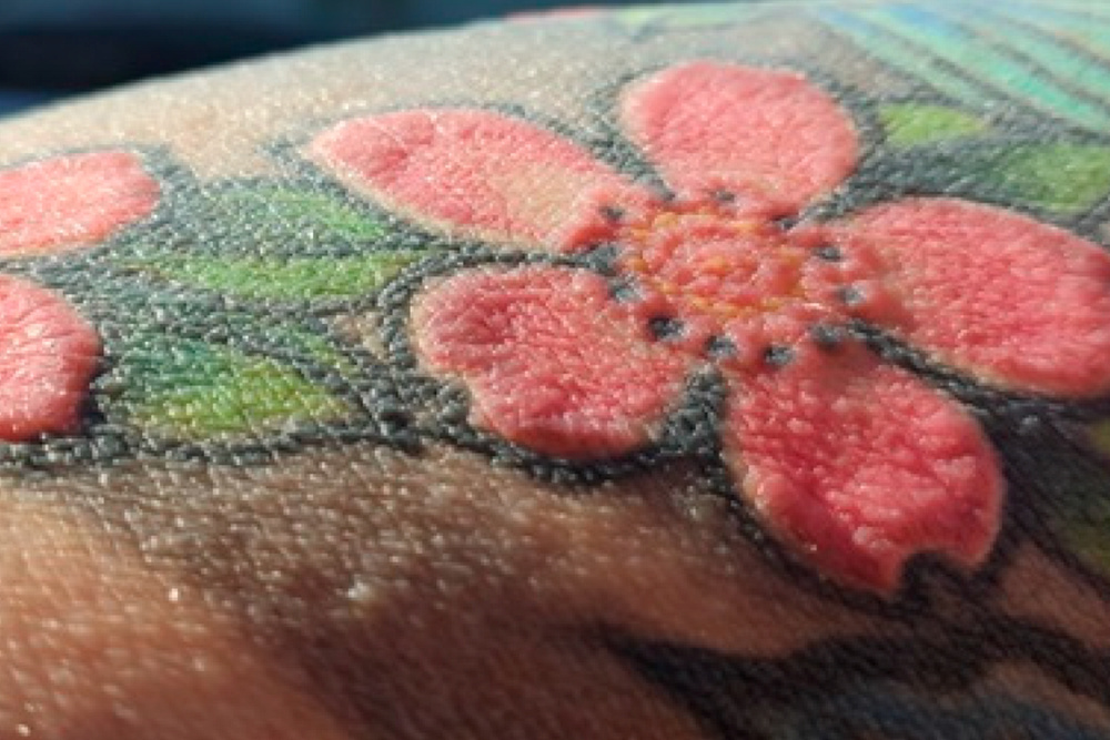 기사 이미지: 문신을 한 후 남자가 머리카락을 모두 잃고 땀을 흘리지 않게 되었다.