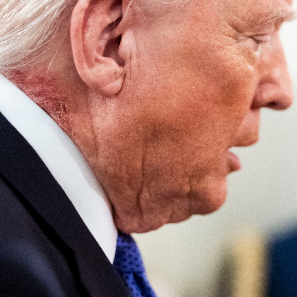 Image for the article: What Is Trump’s Neck Rash? His Doctor Declines to Explain.