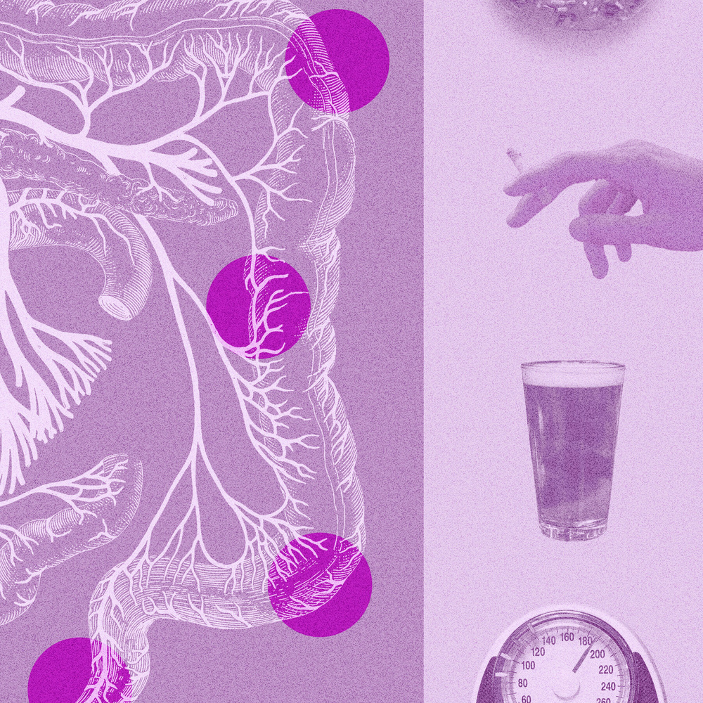 기사 이미지: 대장암 환자의 절반이 65세 미만에서 발생, 연구 결과 발표